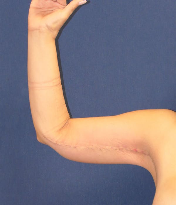Arm Lift (Brachioplasty) Gallery - Patient 504481 - Image 4
