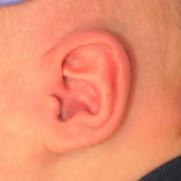 Pediatric Ear Molding Gallery - Patient 156851 - Image 2