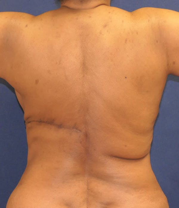 Breast Reconstruction Gallery - Patient 247480 - Image 8