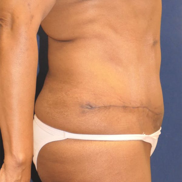 Tummy Tuck (Abdominoplasty) Gallery - Patient 390348 - Image 6