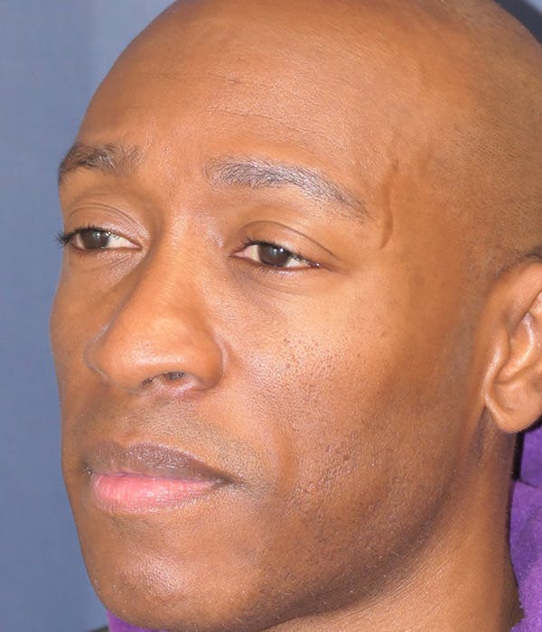 Rhinoplasty Gallery - Patient 305050 - Image 9