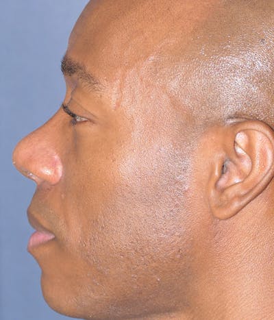 Rhinoplasty Gallery - Patient 305050 - Image 12