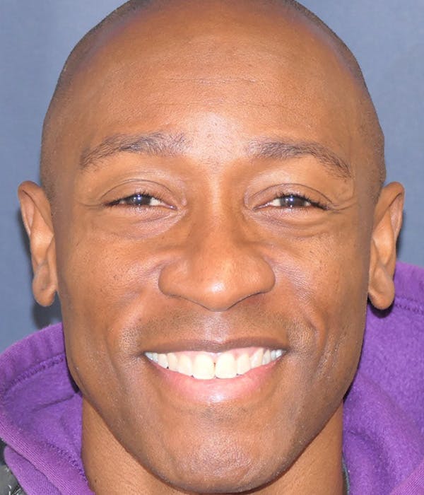 Rhinoplasty Gallery - Patient 305050 - Image 3
