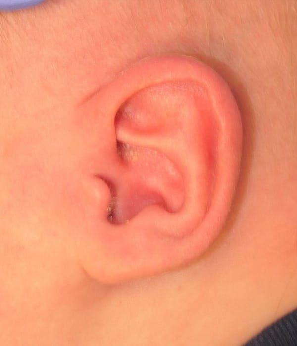 Pediatric Ear Molding Gallery - Patient 231609 - Image 2