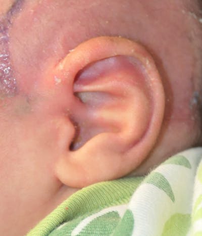 Ear Molding Gallery - Patient 333150 - Image 4