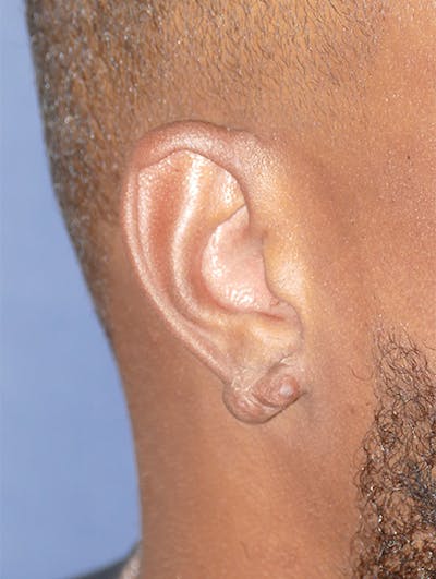 Scars/Malformations Gallery - Patient 423651 - Image 2