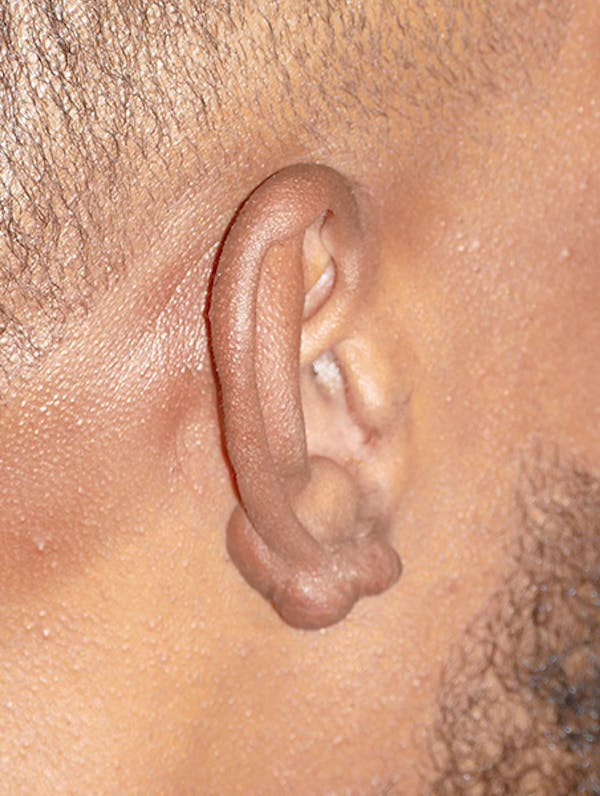 Scars/Malformations Gallery - Patient 423651 - Image 3