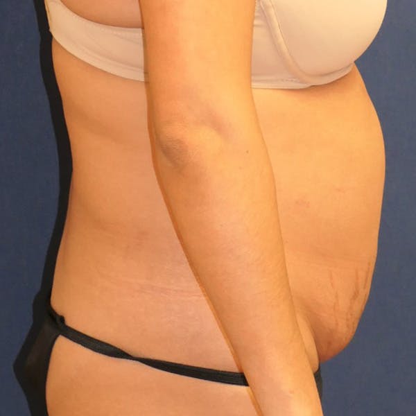 Tummy Tuck (Abdominoplasty) Gallery - Patient 982316 - Image 5