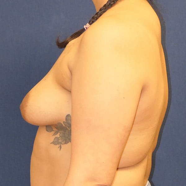 Breast Reconstruction Gallery - Patient 241439 - Image 9