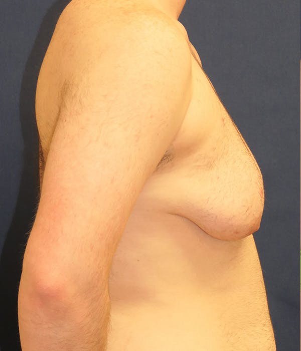 Masculinizing Surgery Gallery - Patient 726173 - Image 3