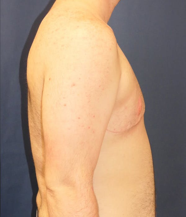 Masculinizing Surgery Gallery - Patient 726173 - Image 4