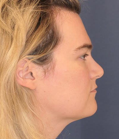 Feminizing Surgery Gallery - Patient 337251 - Image 6