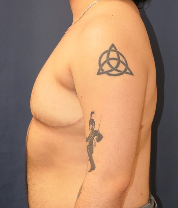Masculinizing Surgery Gallery - Patient 348782 - Image 6