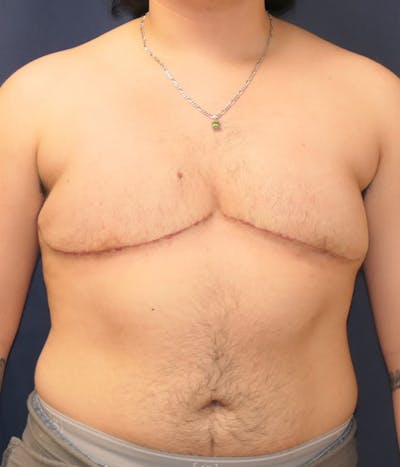 Masculinizing Surgery Gallery - Patient 348782 - Image 2