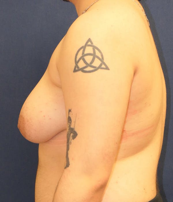 Masculinizing Surgery Gallery - Patient 348782 - Image 5