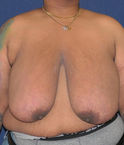Masculinizing Surgery Gallery - Patient 867606 - Image 1