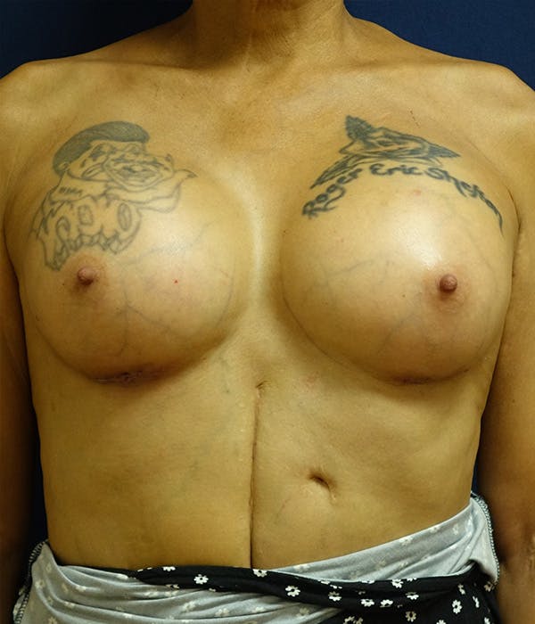 Breast Augmentation Gallery - Patient 190883 - Image 2