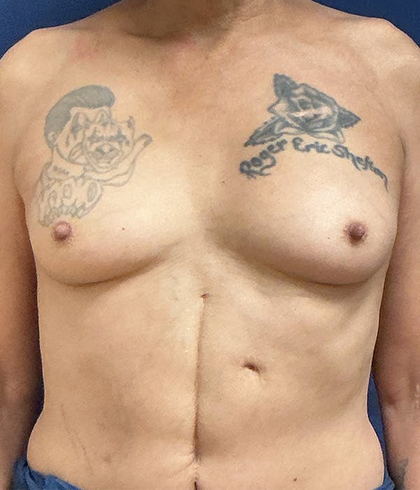 Breast Augmentation Gallery - Patient 190883 - Image 1