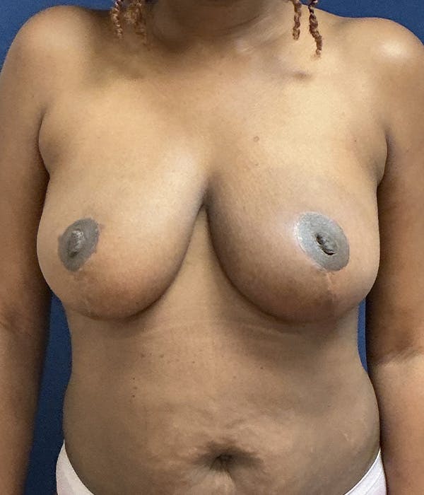 Breast Lift Gallery - Patient 230378 - Image 2