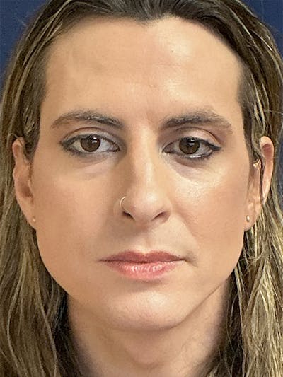 Rhinoplasty Gallery - Patient 379378 - Image 1