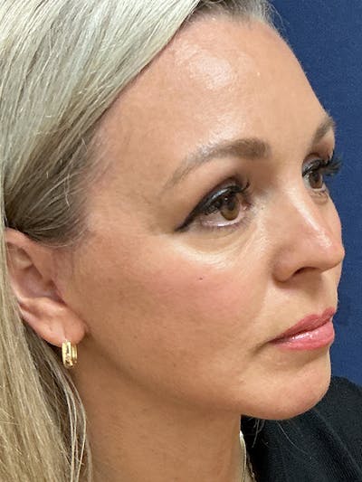 Facelift Gallery - Patient 289541 - Image 4