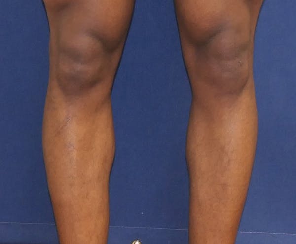 Calf Augmentation with Implants Gallery - Patient 815243 - Image 3