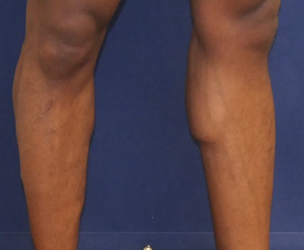 Calf Augmentation with Implants Gallery - Patient 815243 - Image 5