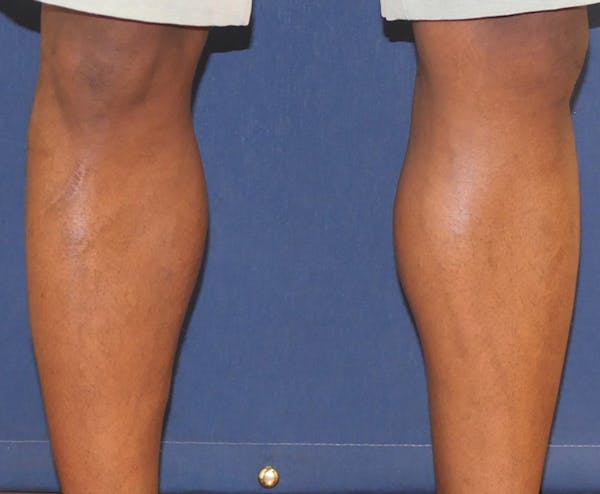 Calf Augmentation with Implants Gallery - Patient 815243 - Image 6