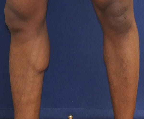 Calf Augmentation with Implants Gallery - Patient 815243 - Image 7
