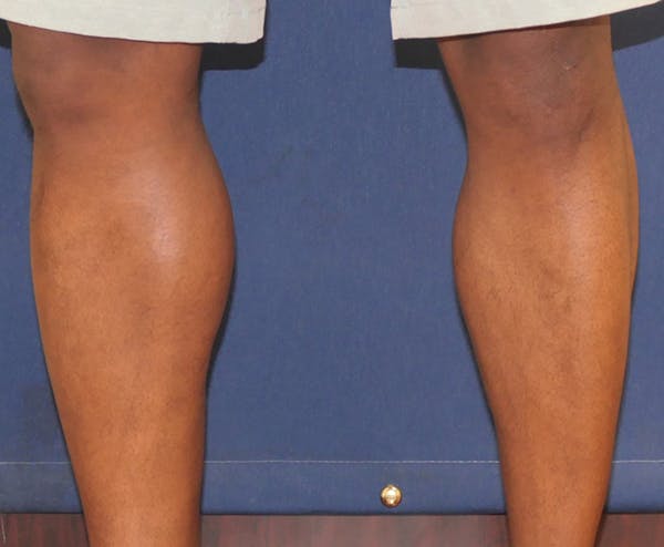 Calf Augmentation with Implants Gallery - Patient 815243 - Image 8