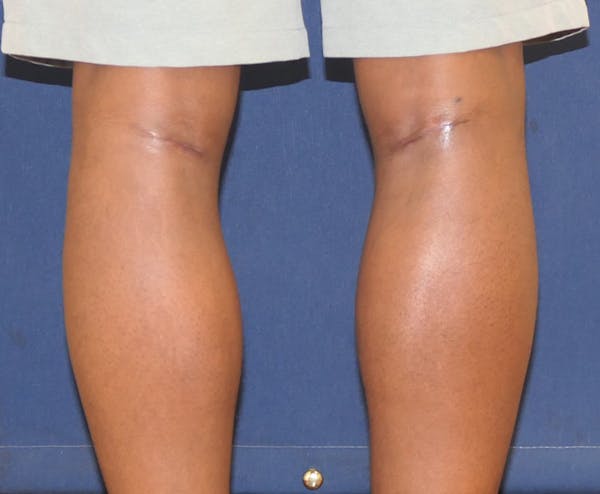 Calf Augmentation with Implants Gallery - Patient 815243 - Image 2
