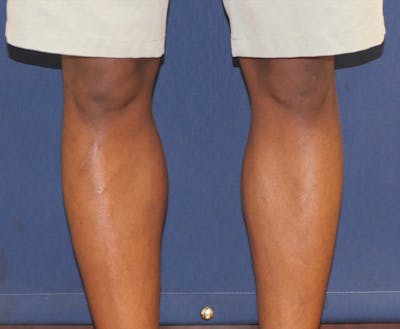Calf Augmentation with Implants Gallery - Patient 815243 - Image 4