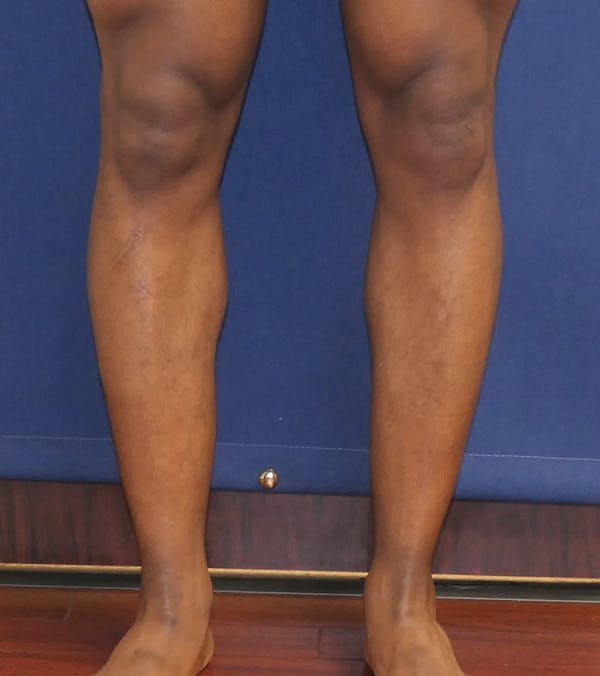 Calf Augmentation with Implants Gallery - Patient 815243 - Image 1
