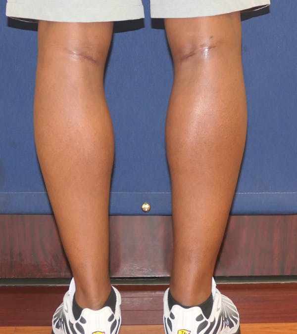 Calf Augmentation with Implants Gallery - Patient 815243 - Image 8