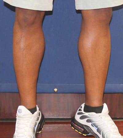 Calf Augmentation with Implants Gallery - Patient 815243 - Image 4