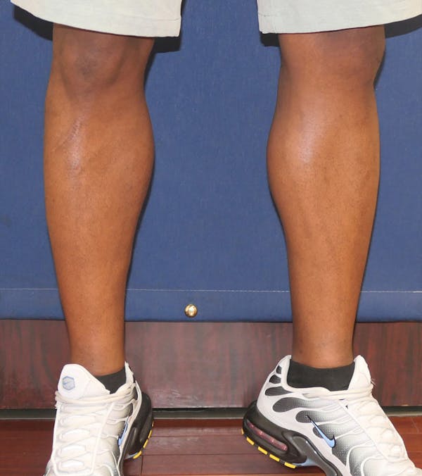 Calf Augmentation with Implants Gallery - Patient 815243 - Image 4