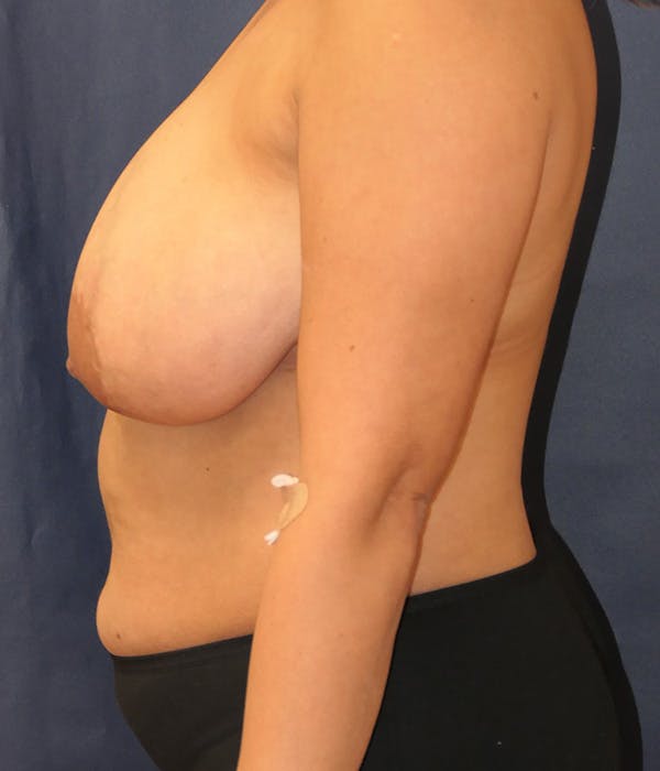 Breast Lift Gallery - Patient 274400 - Image 7