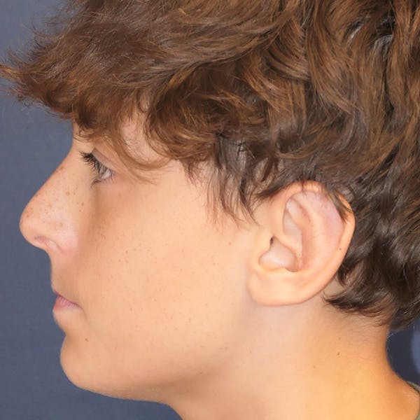 Ear Pinning (Otoplasty) Gallery - Patient 155917 - Image 6