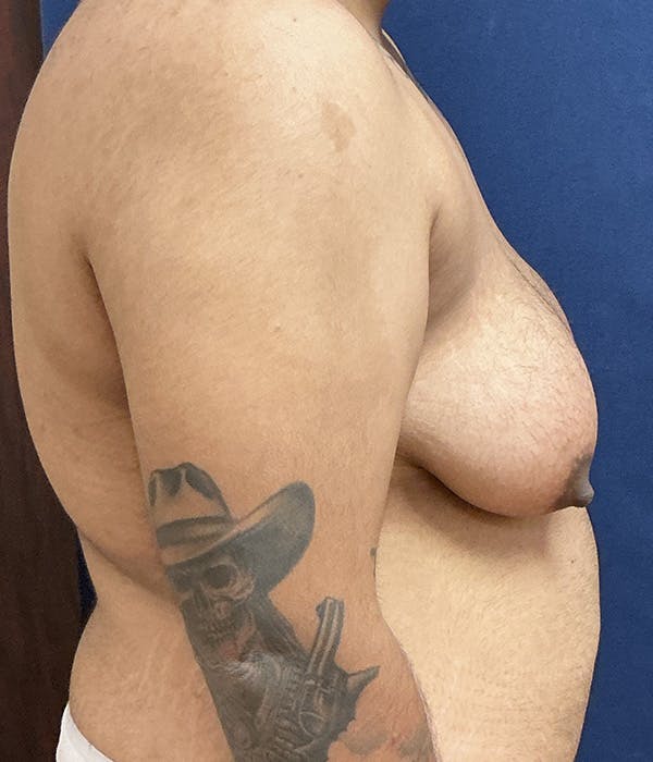Masculinizing Surgery Gallery - Patient 154889 - Image 3