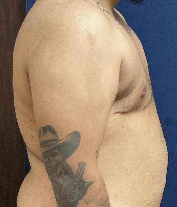 Masculinizing Surgery Gallery - Patient 154889 - Image 4