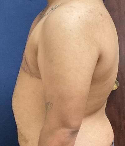 Masculinizing Surgery Gallery - Patient 154889 - Image 6