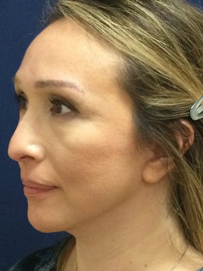 Chin Augmentation Gallery - Patient 244301 - Image 4