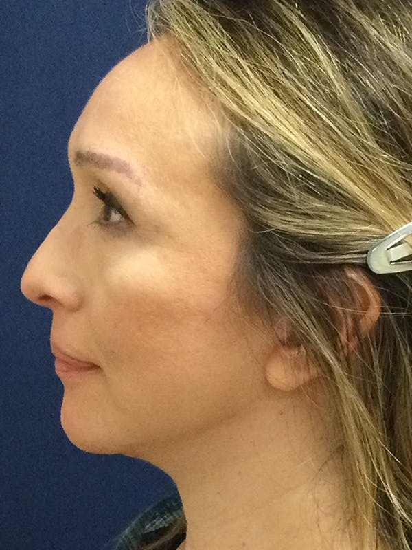 Chin Augmentation Gallery - Patient 244301 - Image 2