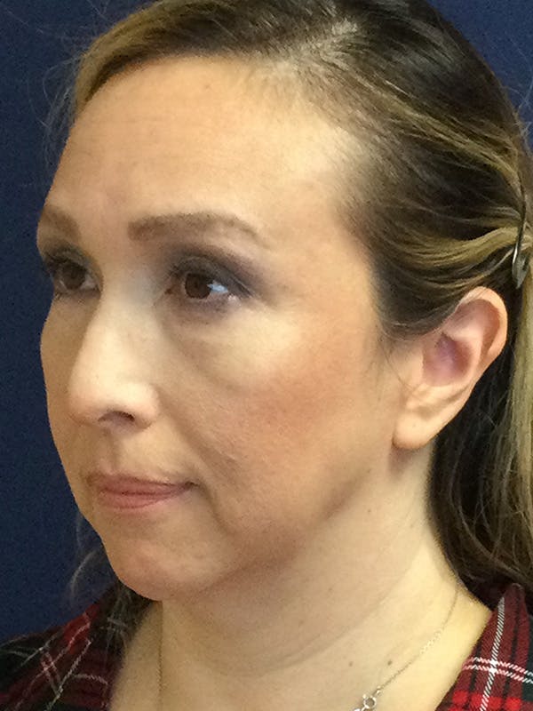 Chin Augmentation Gallery - Patient 244301 - Image 3
