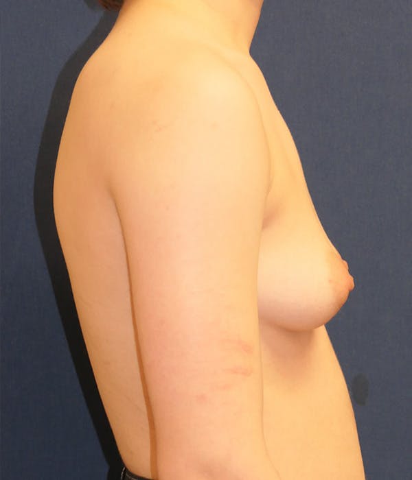 Masculinizing Surgery Gallery - Patient 281792 - Image 3