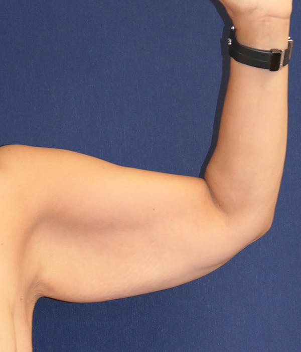 Arm Lift (Brachioplasty) Gallery - Patient 439779 - Image 3