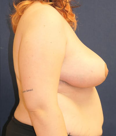 Breast Reduction Gallery - Patient 984636 - Image 6