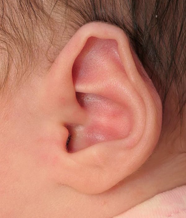 Ear Molding Gallery - Patient 109699 - Image 1