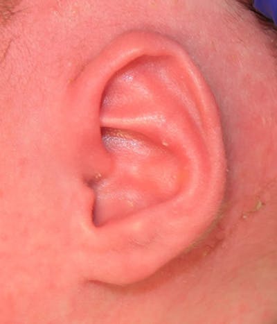 Ear Molding Gallery - Patient 109699 - Image 2