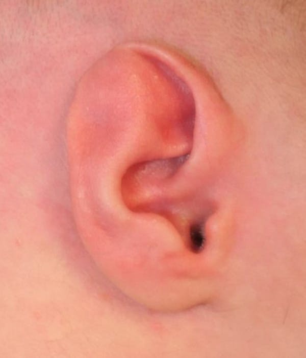 Ear Molding Gallery - Patient 642927 - Image 1